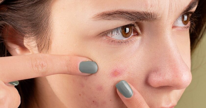 Everything About Cystic Acne: Causes, Symptoms, and Treatment