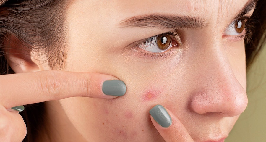 Everything About Cystic Acne Causes, Symptoms, and Treatment